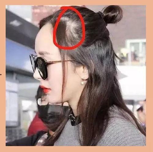 明星发际线,颜值背后的秘密